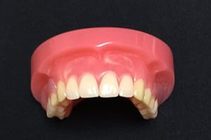 天然の歯に見える部分入れ歯